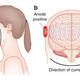 Image for article titled Happiness Is a Warm Transcranial Direct Current Electrode
